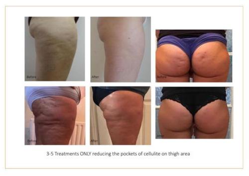 Lipofirm Pro Before and After Images 2018 Layout-07