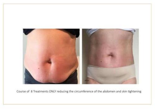 Lipofirm Pro Before and After Images 2018 Layout-09